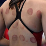 Why Were Olympic Athletes & Other Celebs Spotted with Dark Red Circles on Their Bodies?