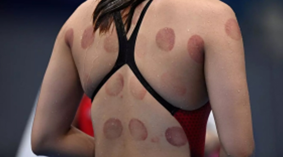 Why Were Olympic Athletes & Other Celebs Spotted with Dark Red Circles on Their Bodies?