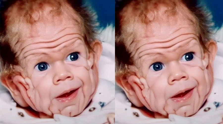 In 1993, This Boy Was Born With Enough Skin For A Five-Year-Old. But Wait Till You See Him Today