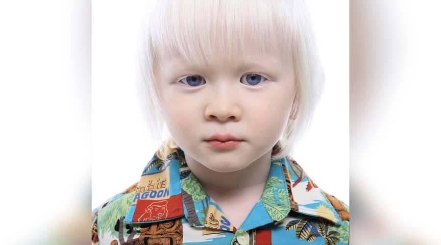 This boy was born 9 years ago with white hair, but here’s what he looks like now.