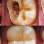 Natural Ways to Repair Cavities and Strengthen Your Teeth