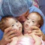 Conjoined twin sisters who were famously ”cut in half” in 2006 and became world pioneers are now living as separate adults.