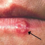 Most People Have Had or Have This Cold Sore Virus, But Very Few Know How to Cure It – Here’s What You Need to Do!