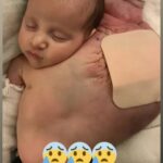 My baby son was born with a cyst the size of a football under his arm