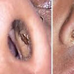 4.. Why You Keep Getting Pimples Inside Your Nose, and What to Do About it