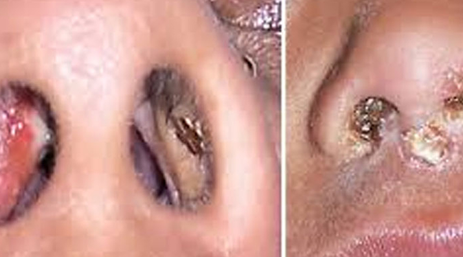 4.. Why You Keep Getting Pimples Inside Your Nose, and What to Do About it